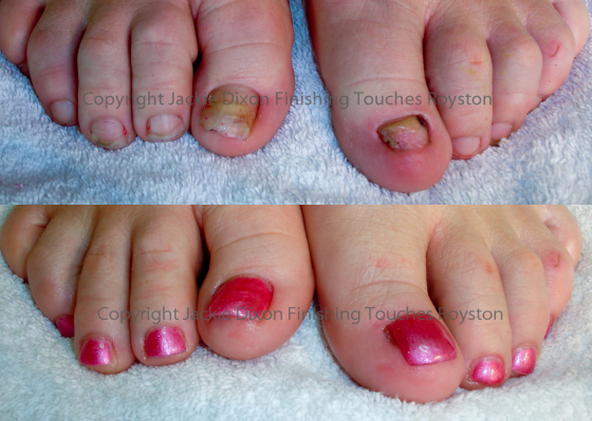 Home Remedies for Big Toe Nail Changing Color and Falling Off - wide 11